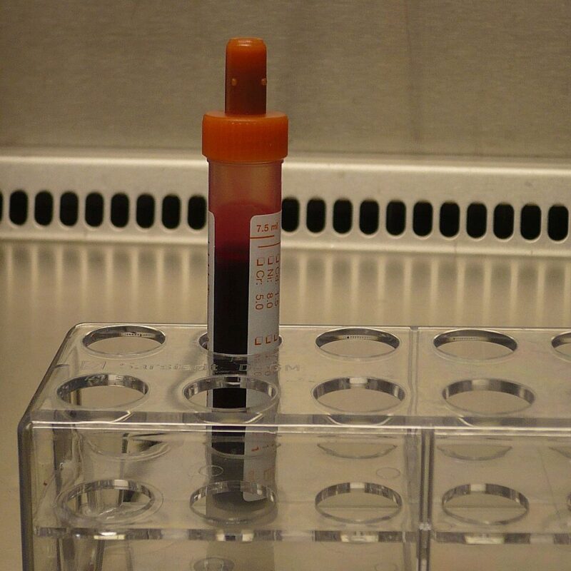 Provetta contenente un campione di sangue in un laboratorio clinico, immagine illustrativa del prelievo